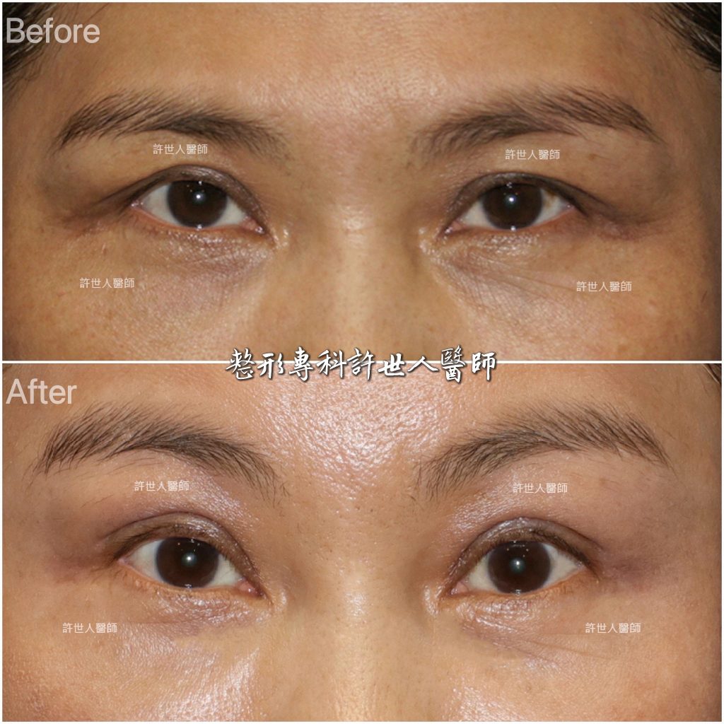 16 內視鏡五爪勾提眉手術 內視鏡五爪鈎前額拉皮提眉術許世人醫師案例分享