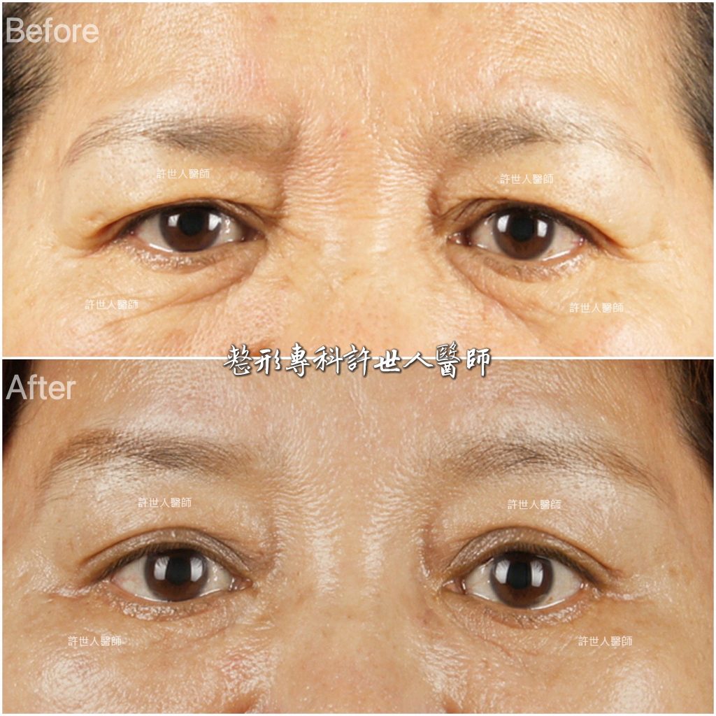 20 內視鏡五爪勾提眉手術) 內視鏡五爪鈎前額拉皮提眉術許世人醫師案例分享