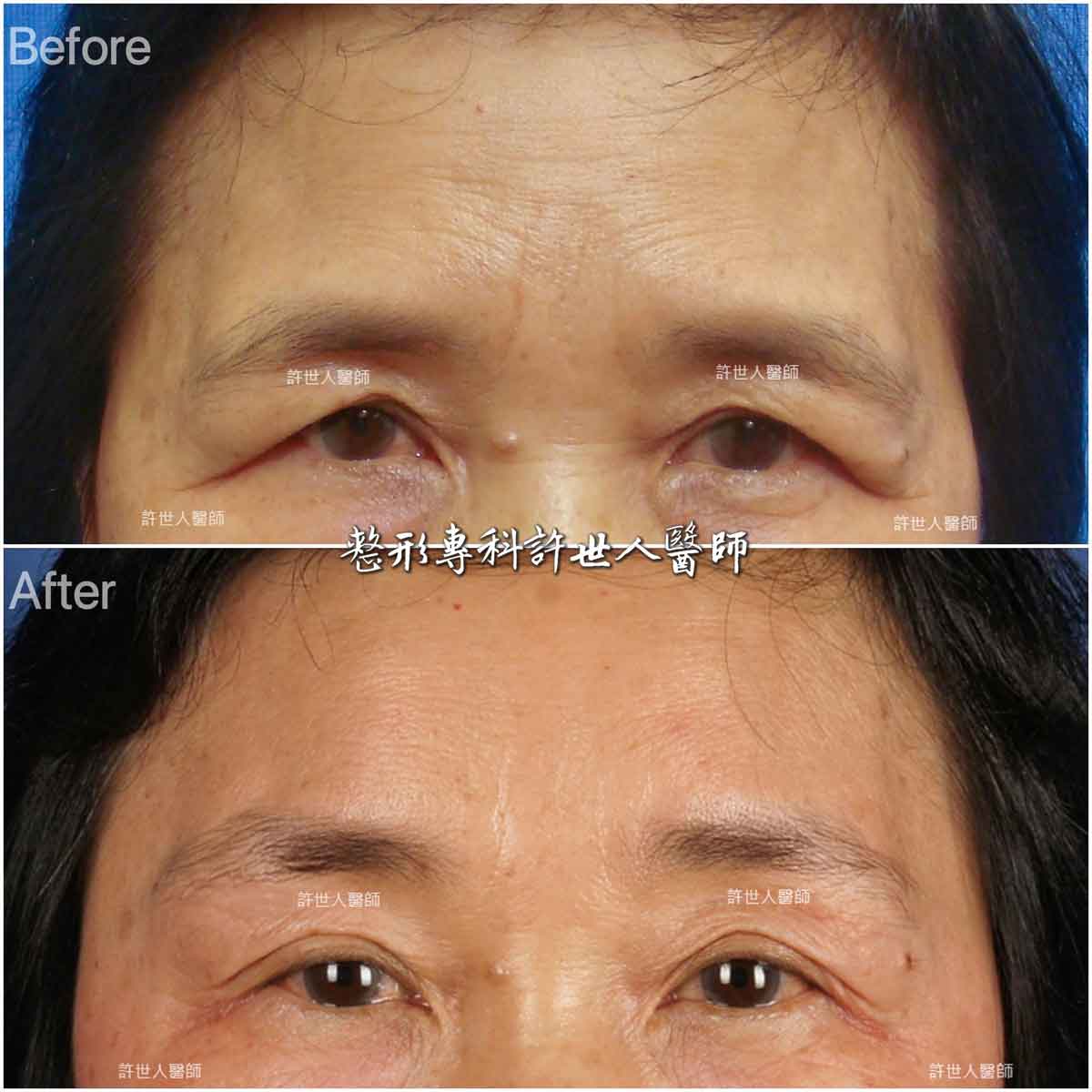 2A-內視鏡提眉手術-(1) 內視鏡五爪鈎前額拉皮提眉術許世人醫師案例分享