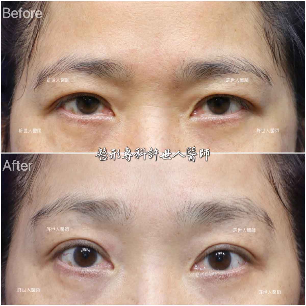 3A–內視鏡提眉+提眼瞼肌手術 內視鏡五爪鈎前額拉皮提眉術許世人醫師案例分享
