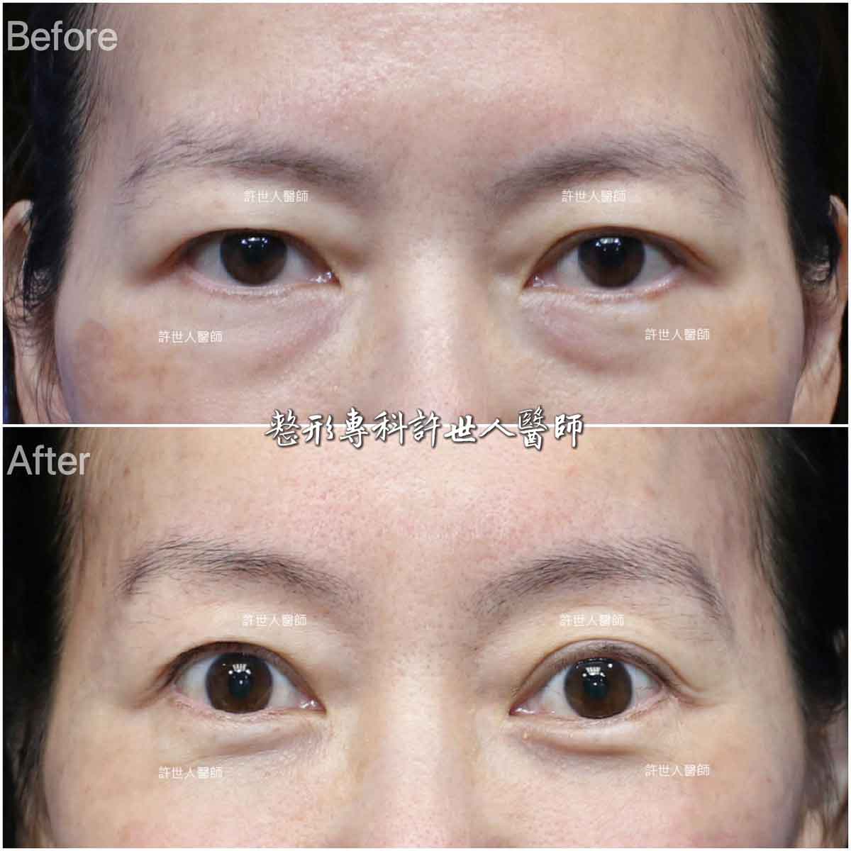 內視鏡五爪鈎前額拉皮提眉術+眼袋內開脂肪移位填淚溝手術許世人醫師案例分享