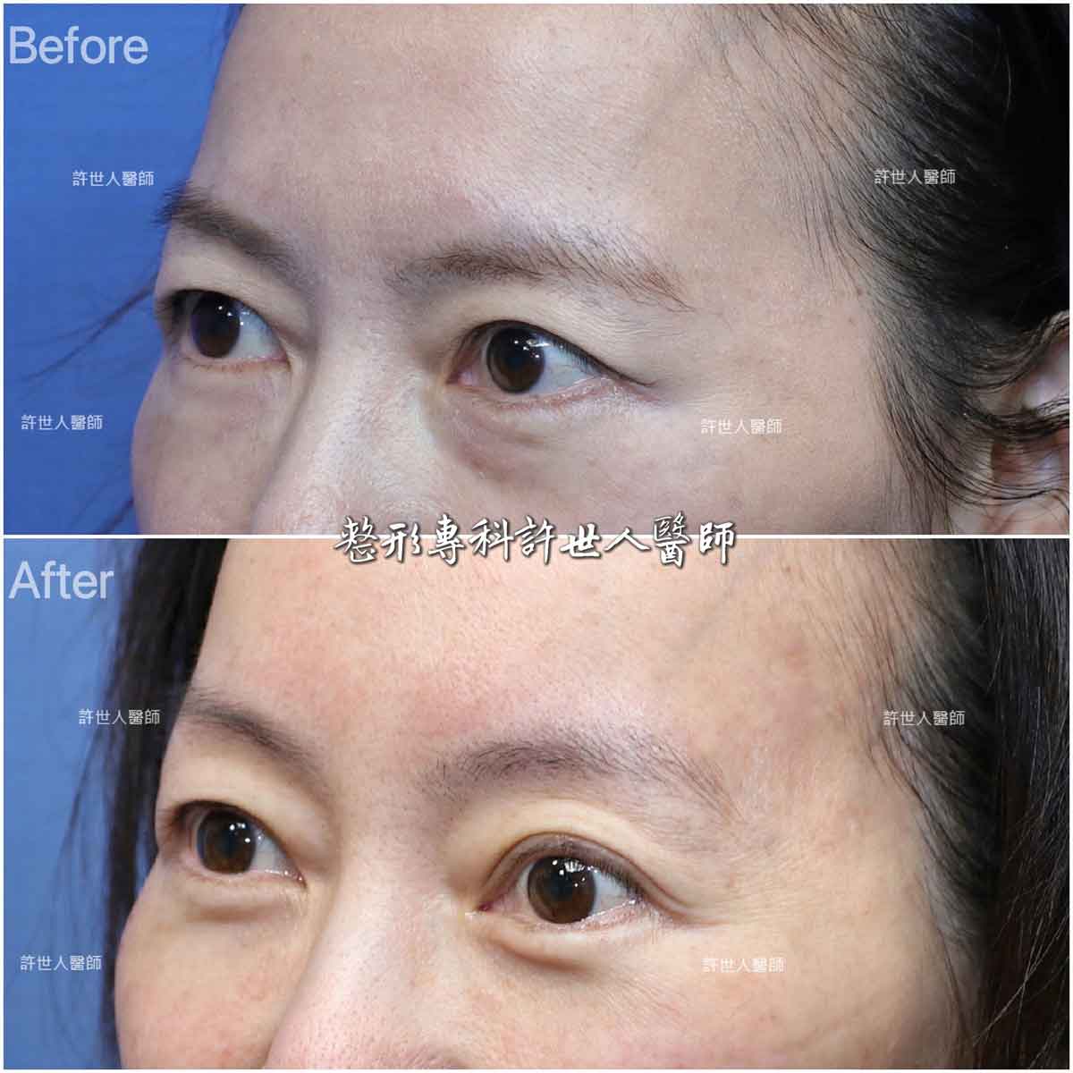 內視鏡五爪鈎前額拉皮提眉術+眼袋內開脂肪移位填淚溝手術許世人醫師案例分享