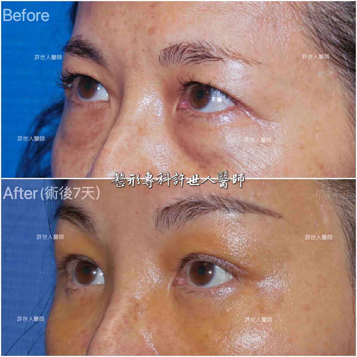 內視鏡五爪鈎前額拉皮提眉術+眼袋內開脂肪移位填淚溝手術許世人醫師案例分享