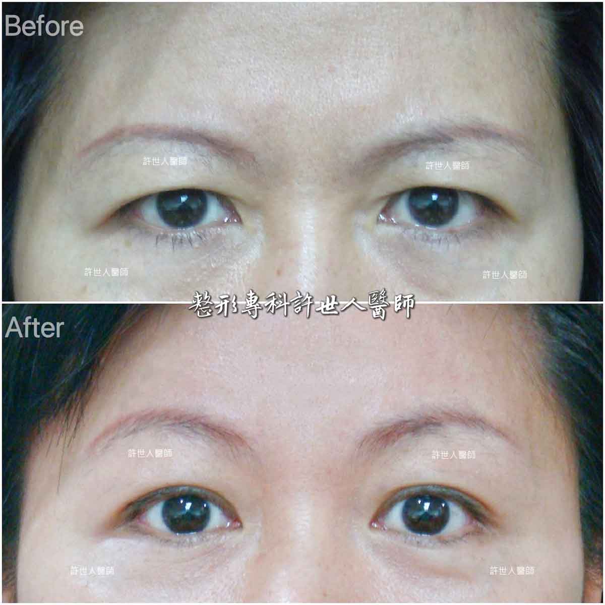 7A-內視鏡五爪勾提眉手術 內視鏡五爪鈎前額拉皮提眉術許世人醫師案例分享