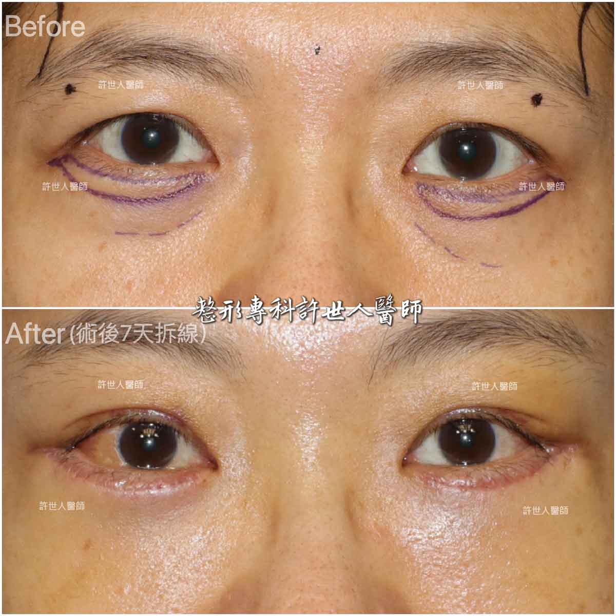 內視鏡五爪鈎提眉＋外開眼袋脂肪移位手術許世人醫師案例分享