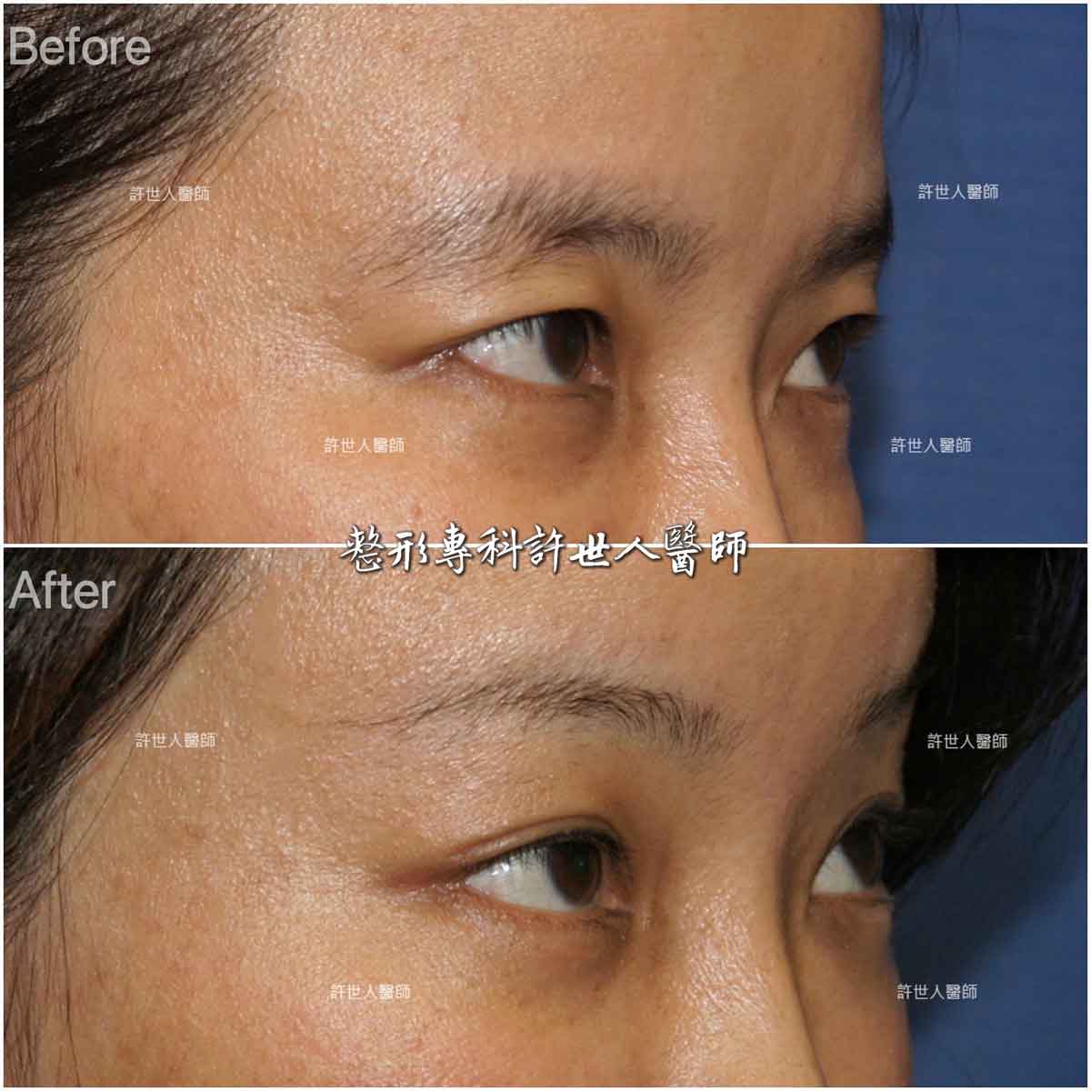 9A–內視鏡提眉+提眼瞼肌手術 內視鏡五爪鈎提眉+提眼瞼肌手術許世人醫師案例分享