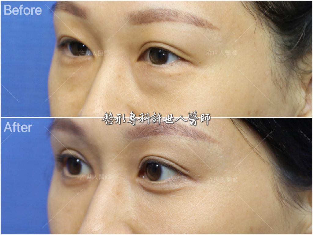 內開眼袋脂肪移位手術＋ 提眼瞼肌+雙眼皮手術  許世人醫師案例分享