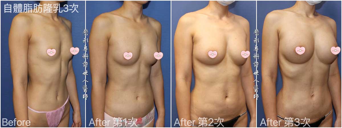 三次威塑抽脂自體脂肪隆乳