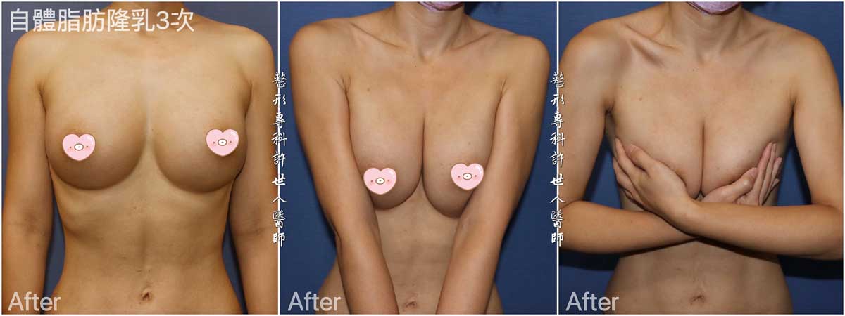 三次威塑抽脂自體脂肪隆乳