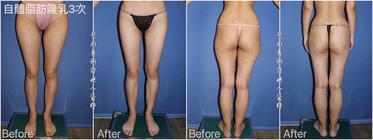 三次威塑抽脂自體脂肪隆乳