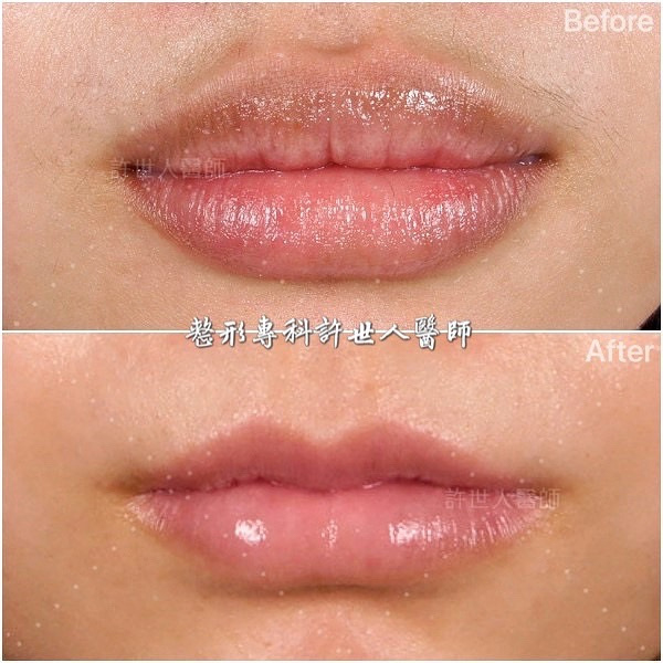 提唇峰手術前後對比｜許世人醫師 Cupid’s bow 唇峰雕塑案例，改善唇峰角度與上唇立體度