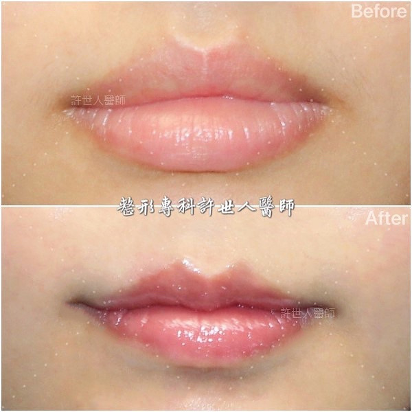 M 型唇雕刻前後對比｜許世人醫師唇型雕刻案例，改善唇峰立體度與上唇線條的唇整形成果