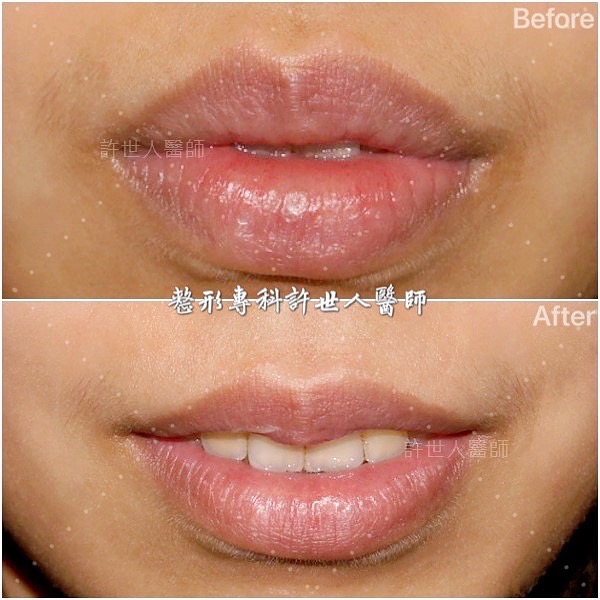 唇整形前後比較，呈現更自然協調的唇形微調效果，由許世人醫師完成。