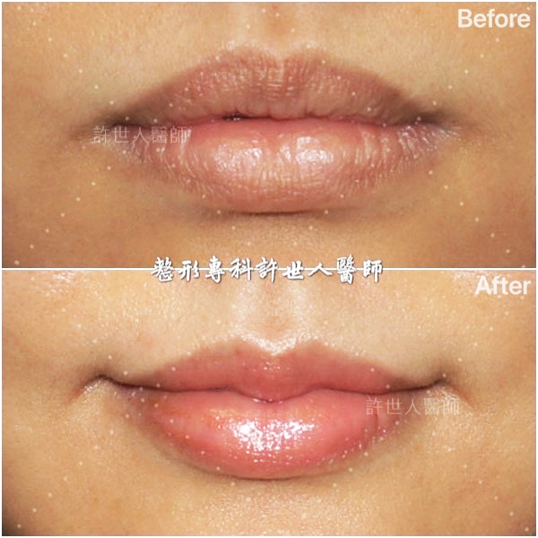 mouth corner lift smile lift before after mrplasty 1