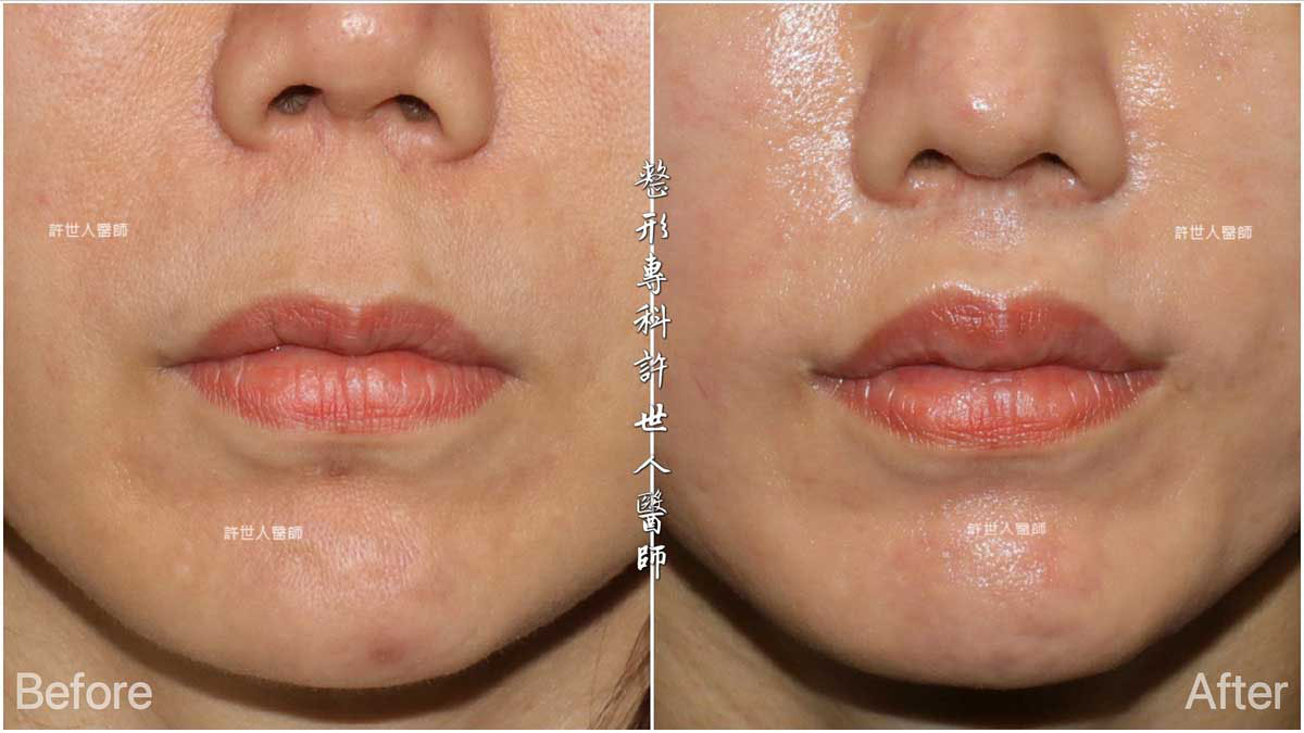 縮人中手術前後對比｜許世人醫師上唇拉提與人中縮短案例，改善老化唇部比例與線條