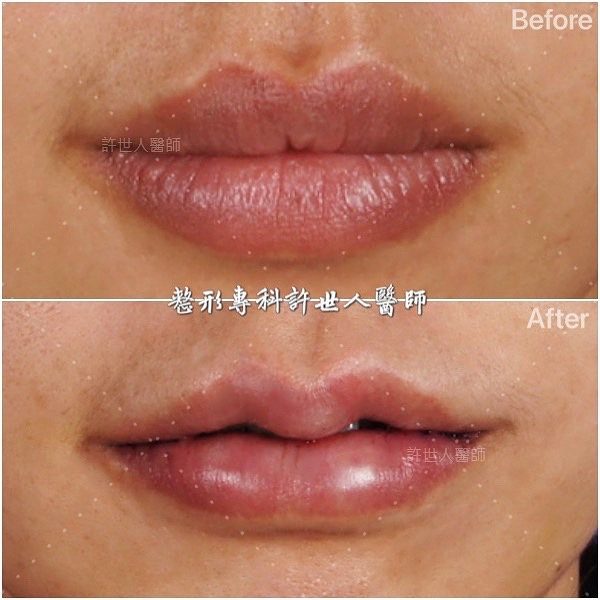 女生 M 型微笑縮唇案例｜許世人醫師縮唇術前後對比