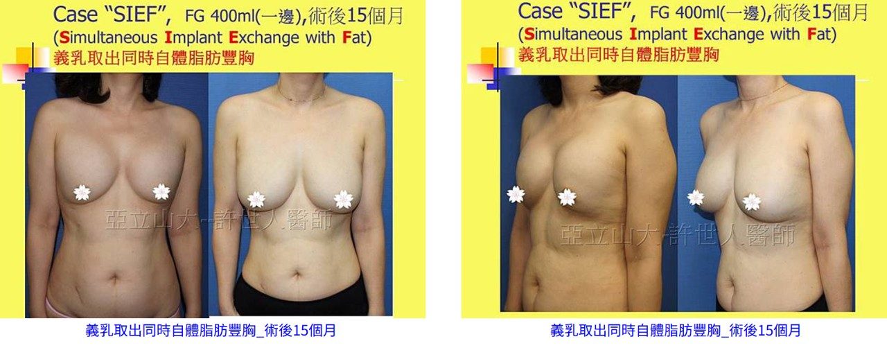 自體脂肪隆乳修復案例 義乳取出合併自體脂肪隆乳修復案例,改善胸型不均與外觀問題