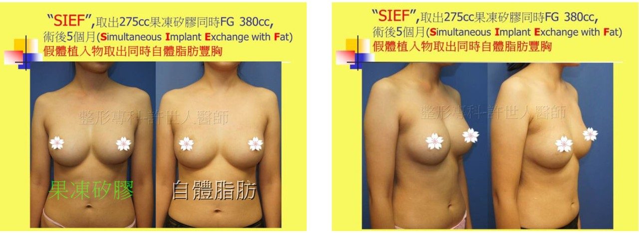 假體取出自體脂肪隆乳案例-2 假體取出後自體脂肪隆乳案例,果凍矽膠取出與自體脂肪豐胸胸型修復對照