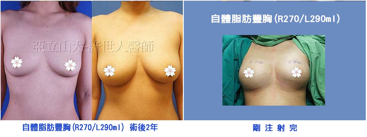 產後自體脂肪隆乳案例 產後自體脂肪隆乳案例,改善產後胸部流失、上胸凹陷與胸型改變