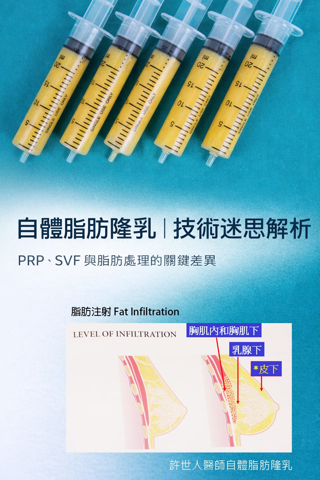 自體脂肪隆乳技術|PRP與SVF脂肪處理差異解析 自體脂肪隆乳技術解析 PRP SVF 脂肪處理過程 台北隆乳推薦